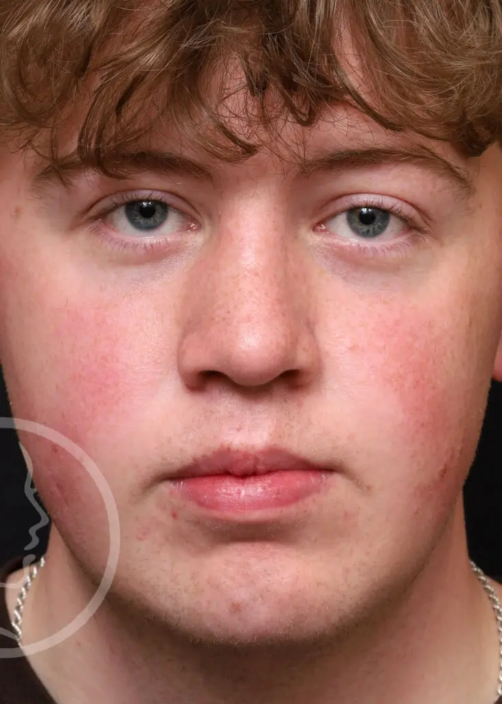 Plastic Surgery Before and After Pictures in Jacksonville, FL - Garcia Facial Plastic Surgery