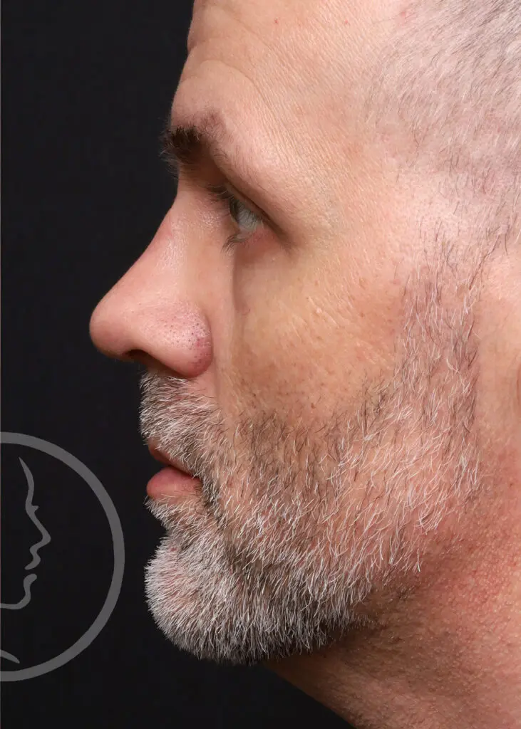 Plastic Surgery Before and After Pictures in Jacksonville, FL - Garcia Facial Plastic Surgery