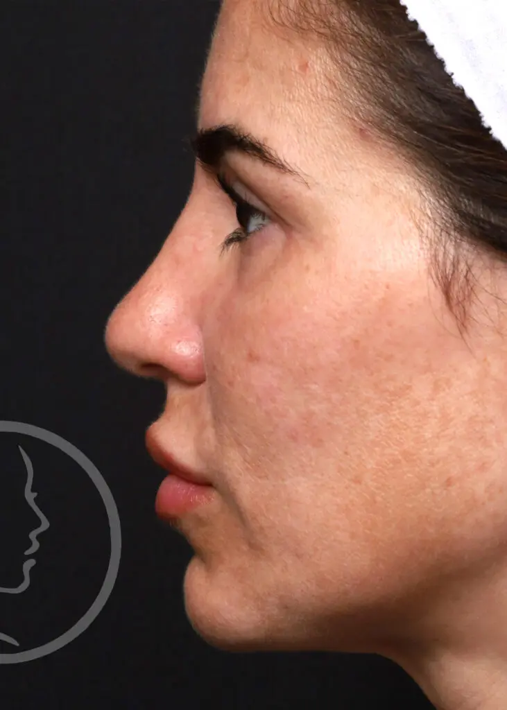 Plastic Surgery Before and After Pictures in Jacksonville, FL - Garcia Facial Plastic Surgery