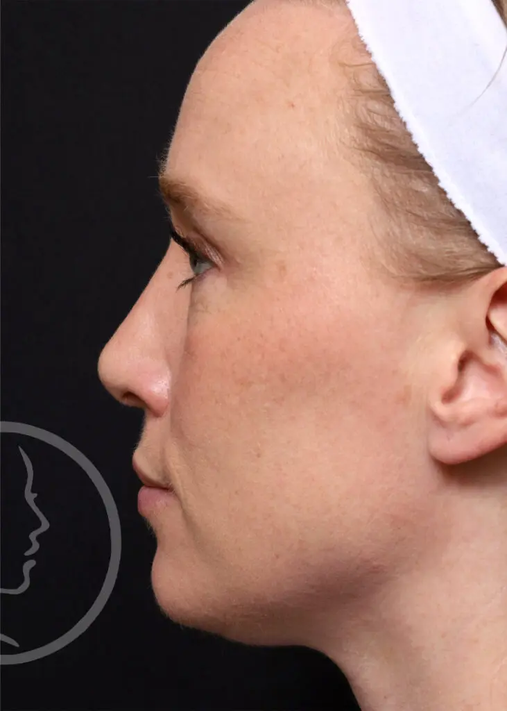 Plastic Surgery Before and After Pictures in Jacksonville, FL - Garcia Facial Plastic Surgery