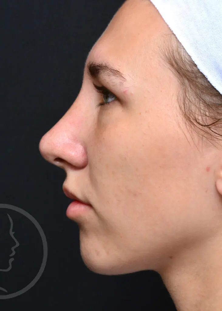 Plastic Surgery Before and After Pictures in Jacksonville, FL - Garcia Facial Plastic Surgery