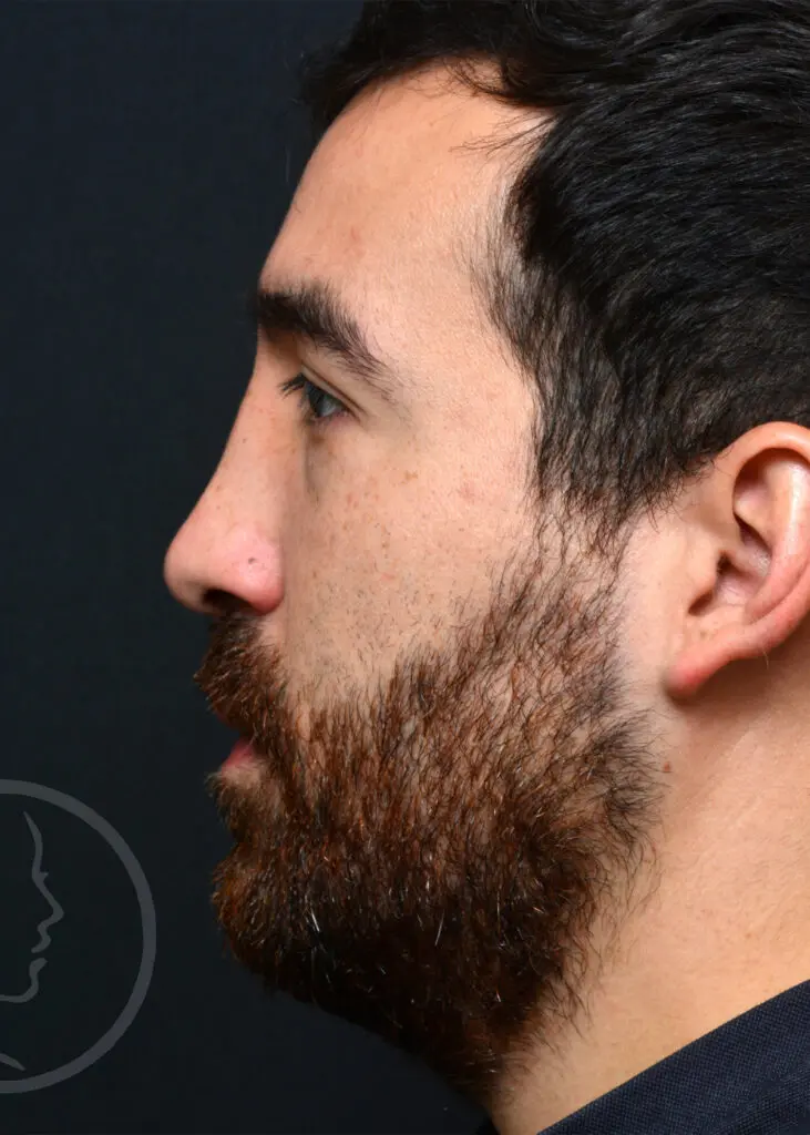 Plastic Surgery Before and After Pictures in Jacksonville, FL - Garcia Facial Plastic Surgery