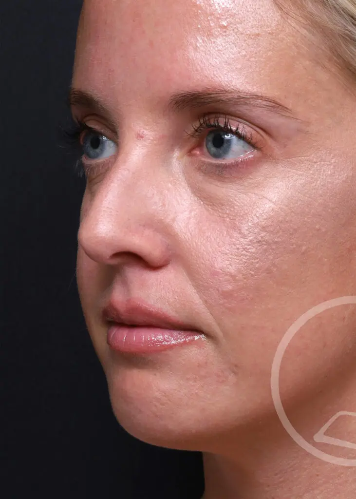 Plastic Surgery Before and After Pictures in Jacksonville, FL - Garcia Facial Plastic Surgery