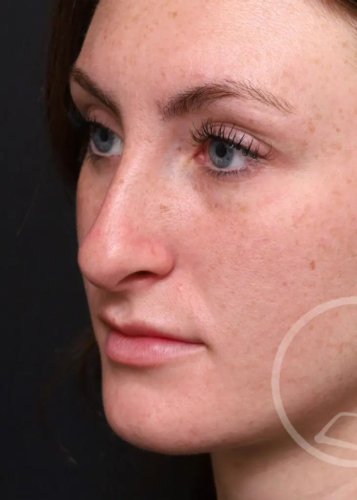 Plastic Surgery Before and After Pictures in Jacksonville, FL - Garcia Facial Plastic Surgery