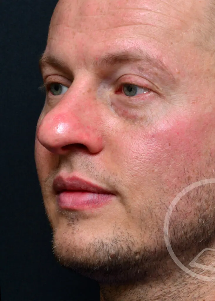 Plastic Surgery Before and After Pictures in Jacksonville, FL - Garcia Facial Plastic Surgery