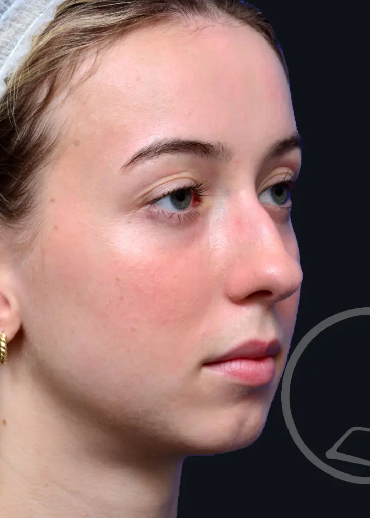 Plastic Surgery Before and After Pictures in Jacksonville, FL - Garcia Facial Plastic Surgery