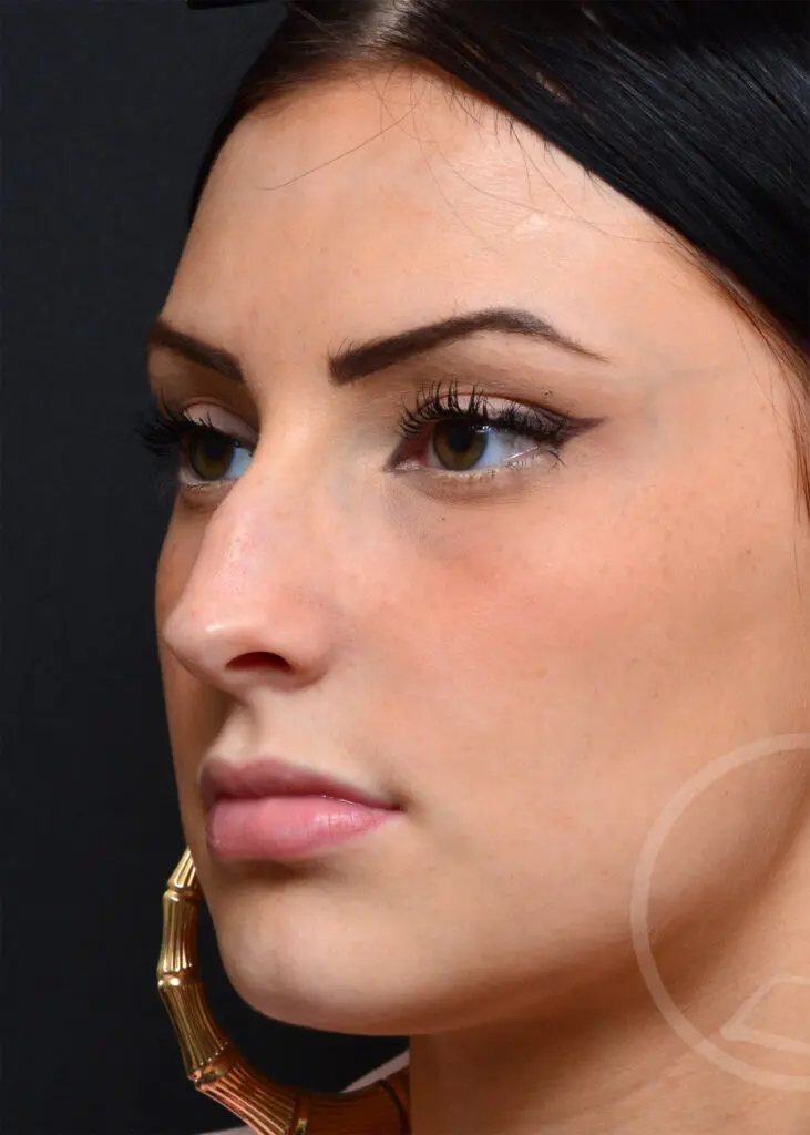 Plastic Surgery Before and After Pictures in Jacksonville, FL - Garcia Facial Plastic Surgery