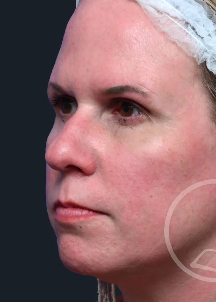 Plastic Surgery Before and After Pictures in Jacksonville, FL - Garcia Facial Plastic Surgery