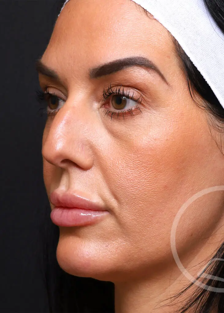 Plastic Surgery Before and After Pictures in Jacksonville, FL - Garcia Facial Plastic Surgery