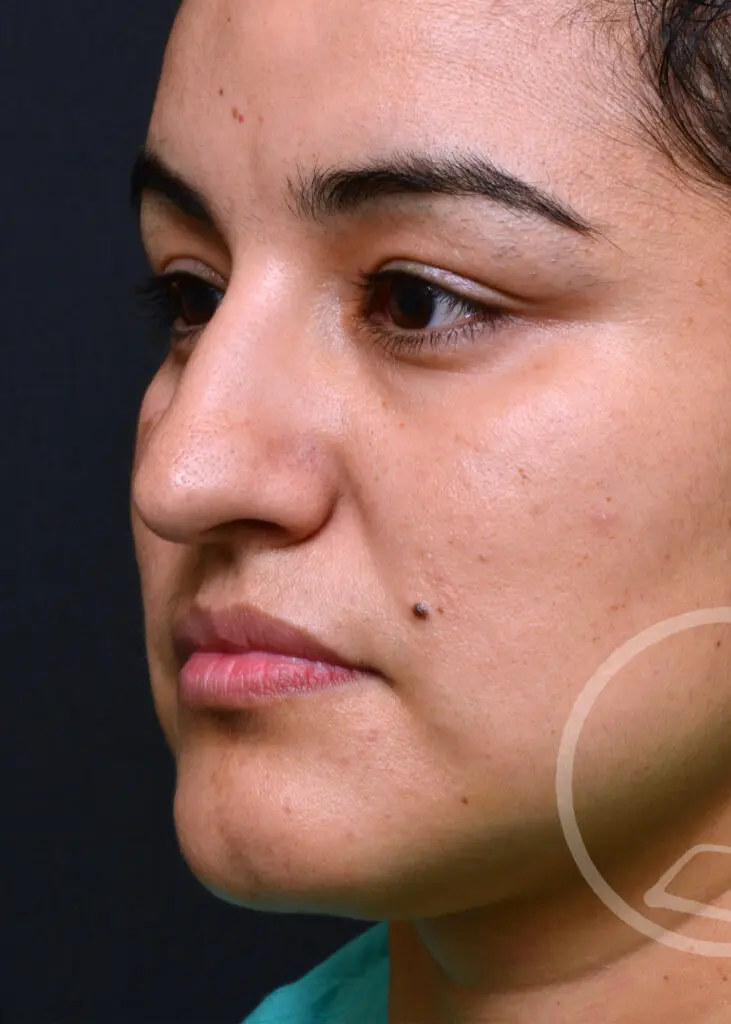 Plastic Surgery Before and After Pictures in Jacksonville, FL - Garcia Facial Plastic Surgery