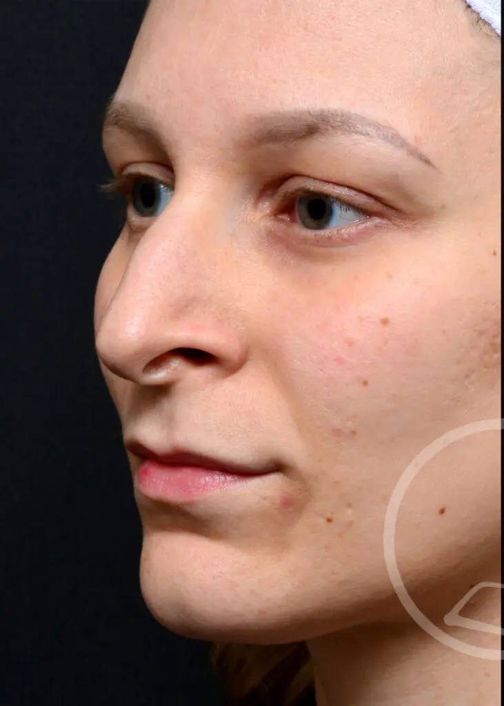 Plastic Surgery Before and After Pictures in Jacksonville, FL - Garcia Facial Plastic Surgery