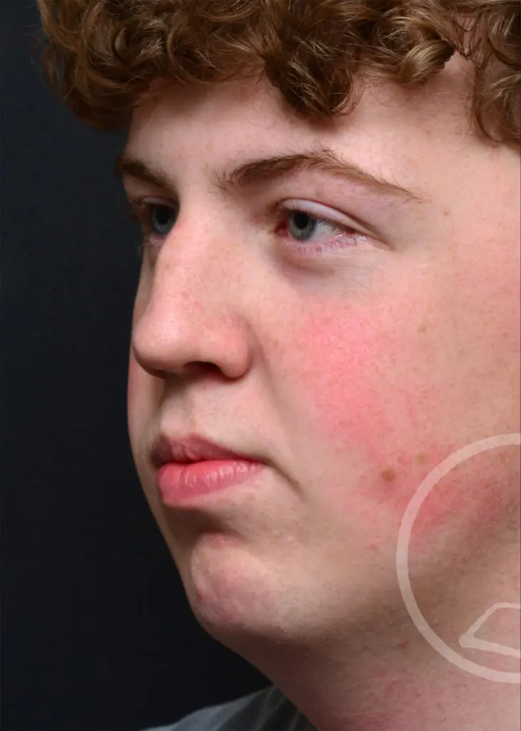 Plastic Surgery Before and After Pictures in Jacksonville, FL - Garcia Facial Plastic Surgery