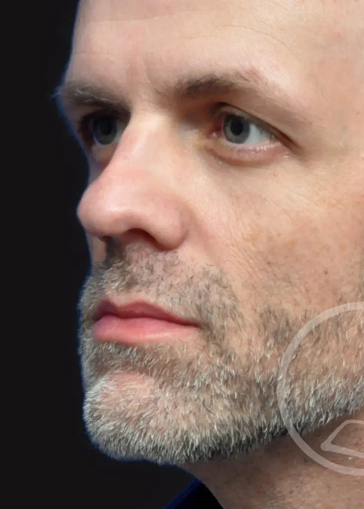 Plastic Surgery Before and After Pictures in Jacksonville, FL - Garcia Facial Plastic Surgery