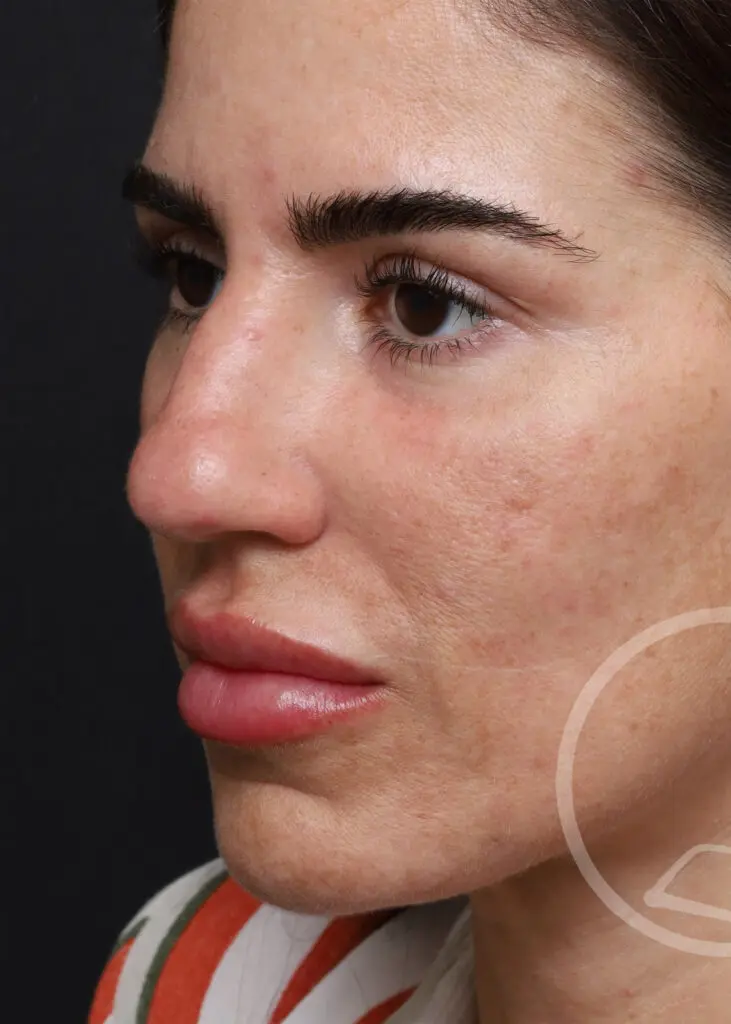 Plastic Surgery Before and After Pictures in Jacksonville, FL - Garcia Facial Plastic Surgery