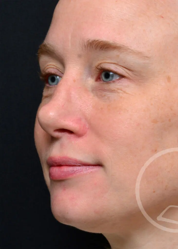 Plastic Surgery Before and After Pictures in Jacksonville, FL - Garcia Facial Plastic Surgery