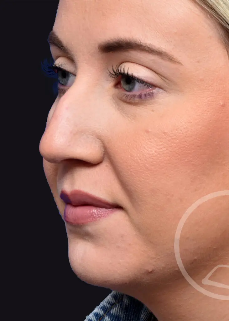 Plastic Surgery Before and After Pictures in Jacksonville, FL - Garcia Facial Plastic Surgery