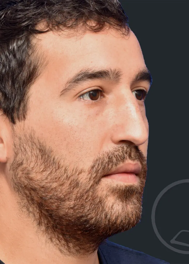 Plastic Surgery Before and After Pictures in Jacksonville, FL - Garcia Facial Plastic Surgery