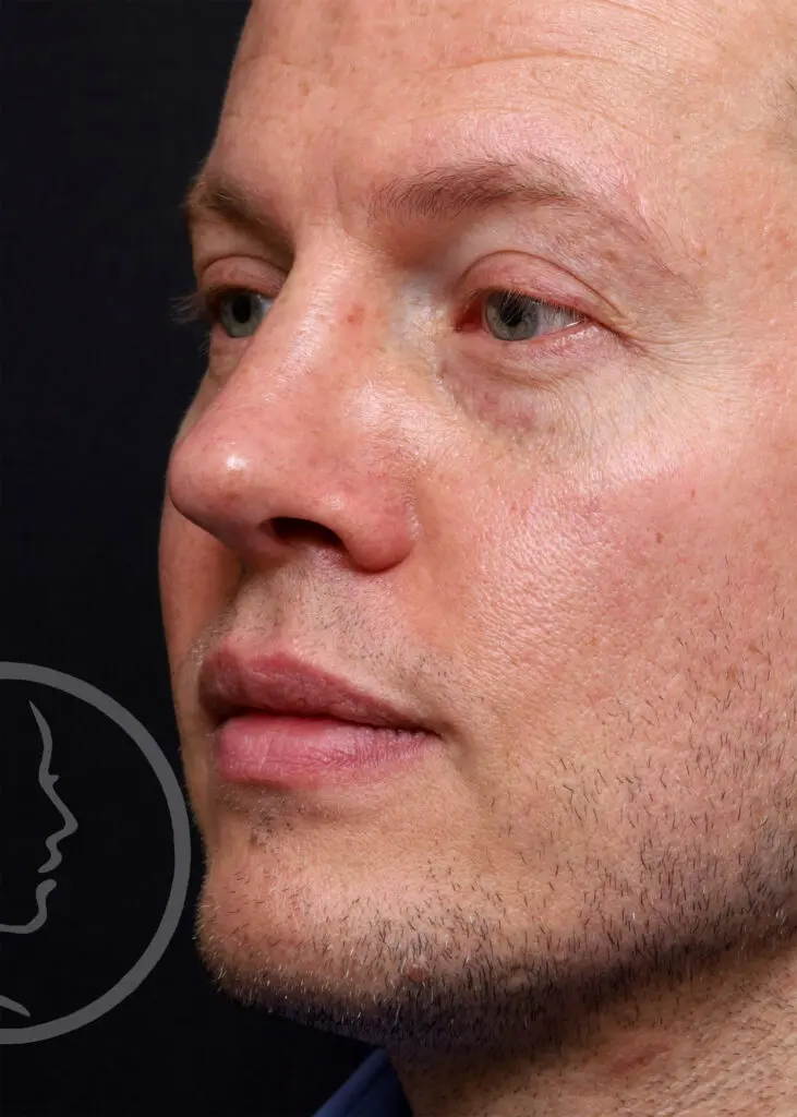 Plastic Surgery Before and After Pictures in Jacksonville, FL - Garcia Facial Plastic Surgery