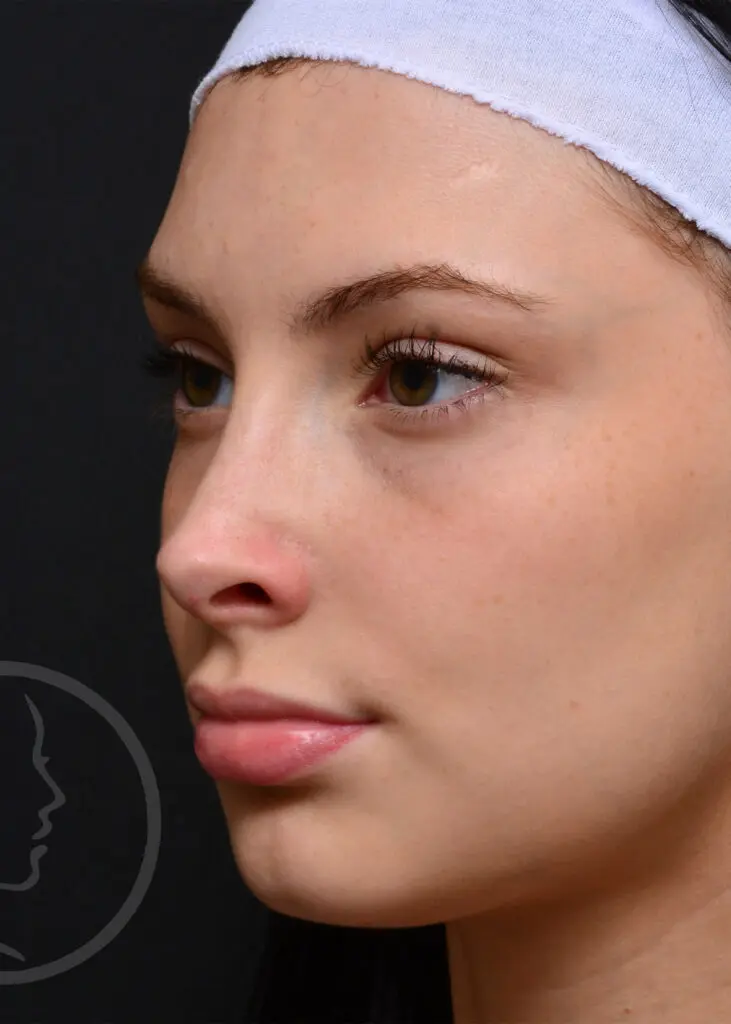 Plastic Surgery Before and After Pictures in Jacksonville, FL - Garcia Facial Plastic Surgery