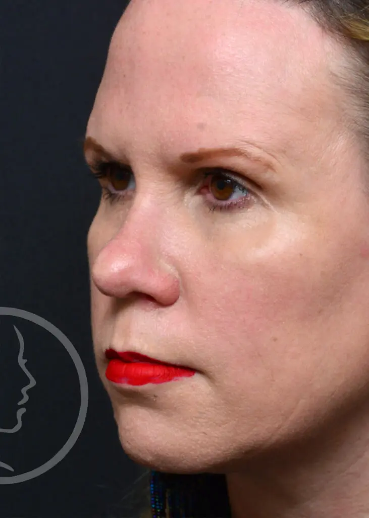 Plastic Surgery Before and After Pictures in Jacksonville, FL - Garcia Facial Plastic Surgery