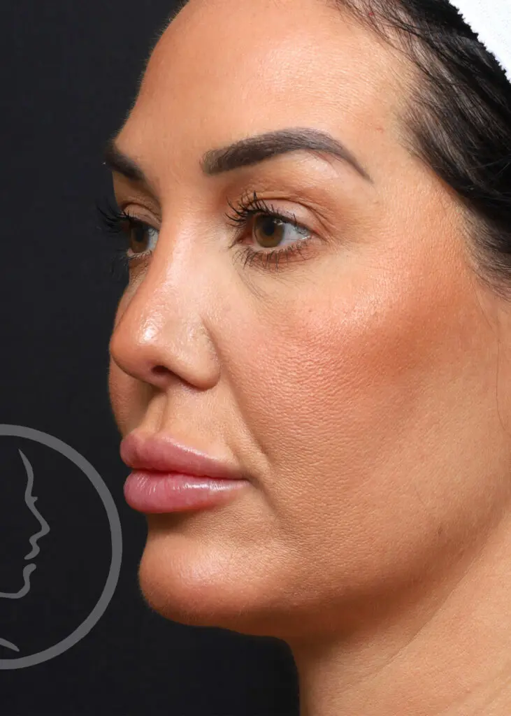 Plastic Surgery Before and After Pictures in Jacksonville, FL - Garcia Facial Plastic Surgery