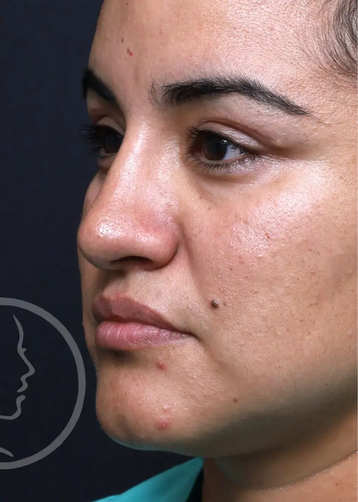 Plastic Surgery Before and After Pictures in Jacksonville, FL - Garcia Facial Plastic Surgery