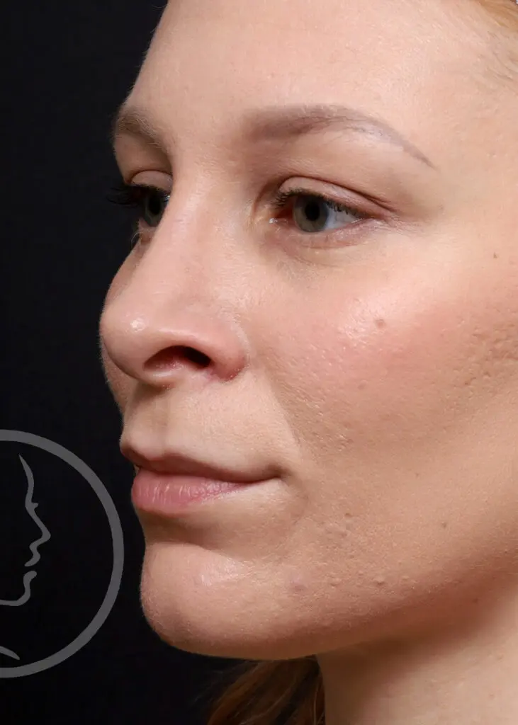 Plastic Surgery Before and After Pictures in Jacksonville, FL - Garcia Facial Plastic Surgery