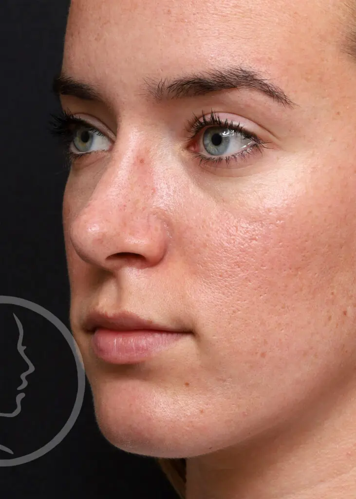 Plastic Surgery Before and After Pictures in Jacksonville, FL - Garcia Facial Plastic Surgery