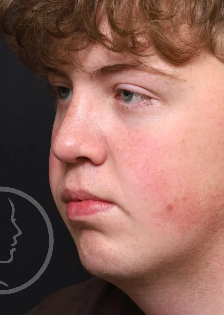 Plastic Surgery Before and After Pictures in Jacksonville, FL - Garcia Facial Plastic Surgery