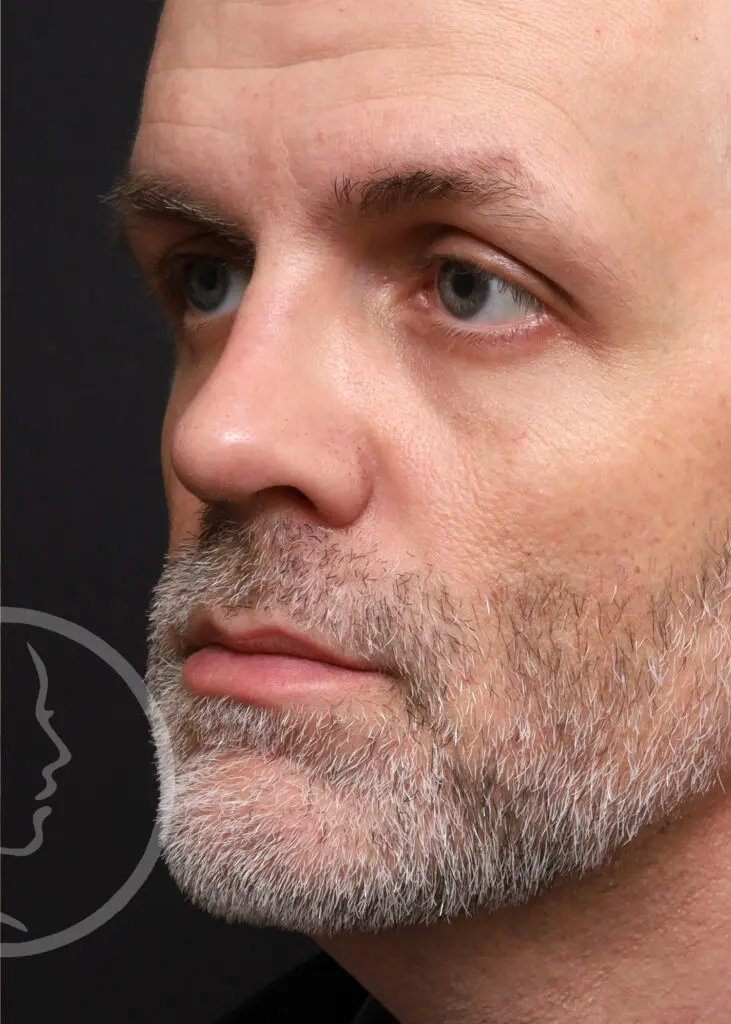 Plastic Surgery Before and After Pictures in Jacksonville, FL - Garcia Facial Plastic Surgery