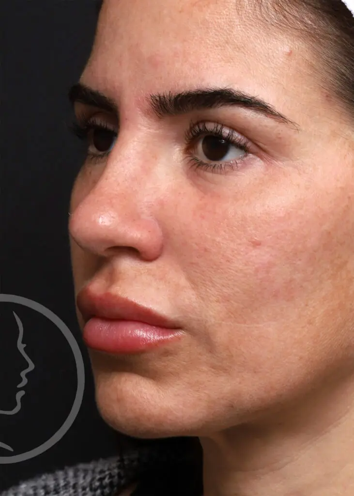 Plastic Surgery Before and After Pictures in Jacksonville, FL - Garcia Facial Plastic Surgery