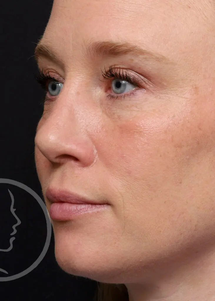 Plastic Surgery Before and After Pictures in Jacksonville, FL - Garcia Facial Plastic Surgery