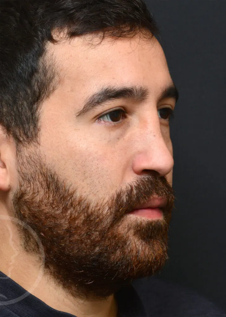 Plastic Surgery Before and After Pictures in Jacksonville, FL - Garcia Facial Plastic Surgery