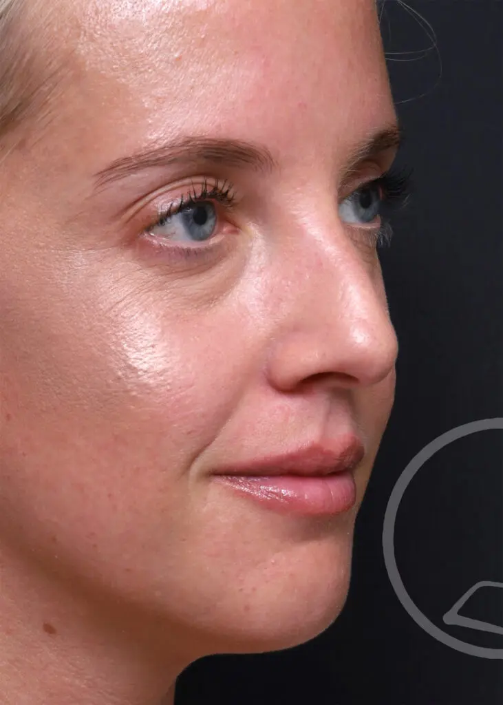 Plastic Surgery Before and After Pictures in Jacksonville, FL - Garcia Facial Plastic Surgery