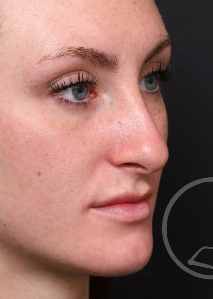 Plastic Surgery Before and After Pictures in Jacksonville, FL - Garcia Facial Plastic Surgery