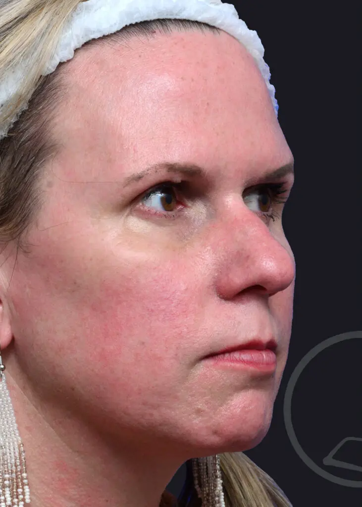 Plastic Surgery Before and After Pictures in Jacksonville, FL - Garcia Facial Plastic Surgery