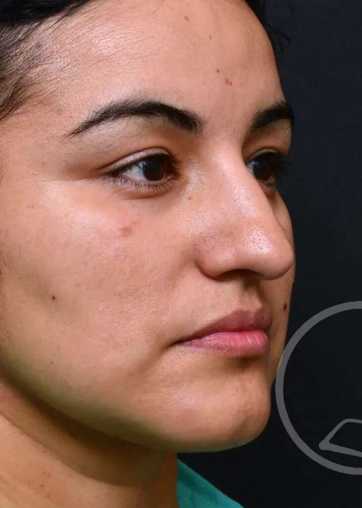 Plastic Surgery Before and After Pictures in Jacksonville, FL - Garcia Facial Plastic Surgery