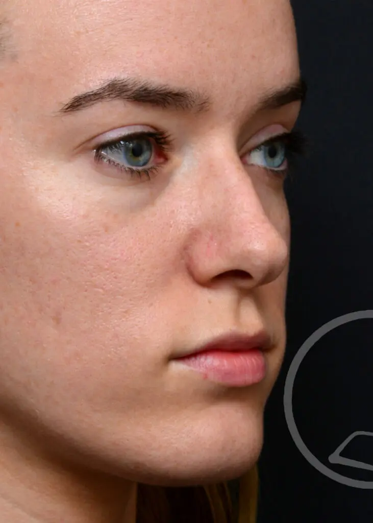 Plastic Surgery Before and After Pictures in Jacksonville, FL - Garcia Facial Plastic Surgery