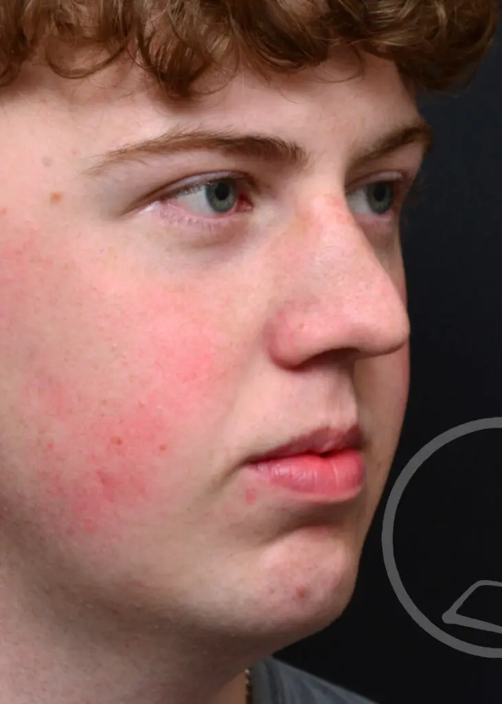 Plastic Surgery Before and After Pictures in Jacksonville, FL - Garcia Facial Plastic Surgery