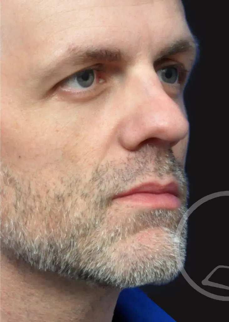 Plastic Surgery Before and After Pictures in Jacksonville, FL - Garcia Facial Plastic Surgery