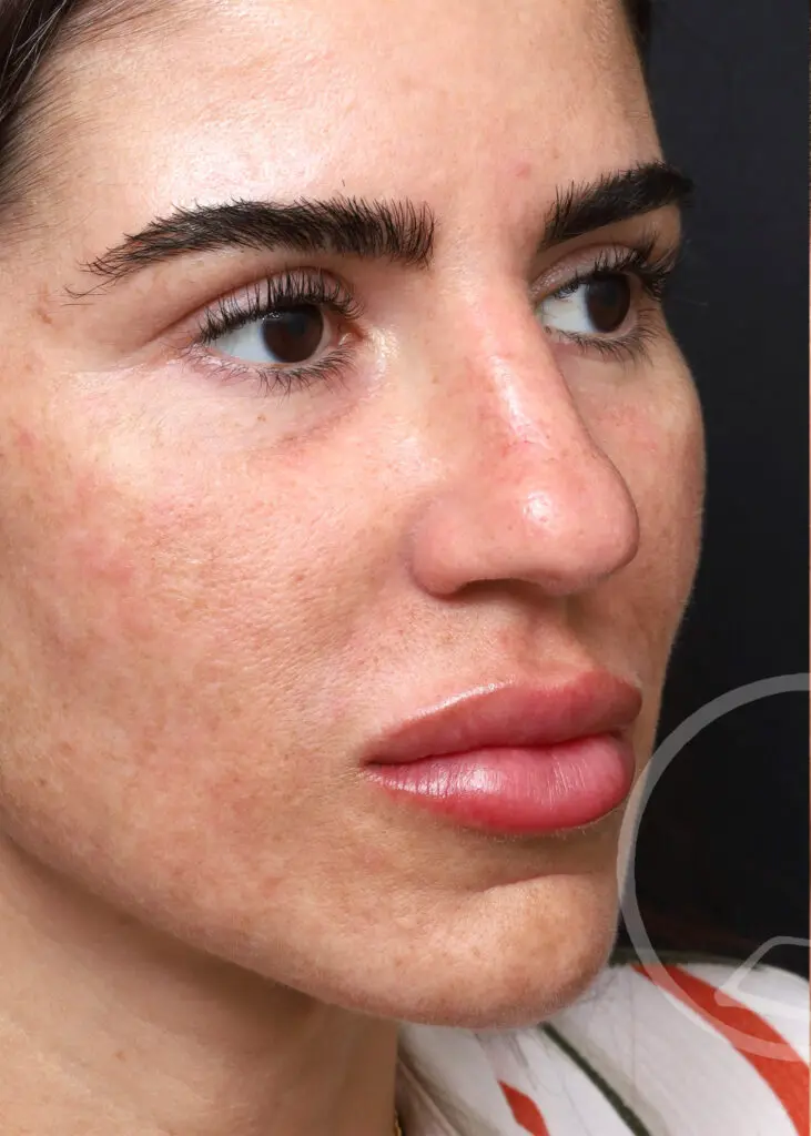 Plastic Surgery Before and After Pictures in Jacksonville, FL - Garcia Facial Plastic Surgery