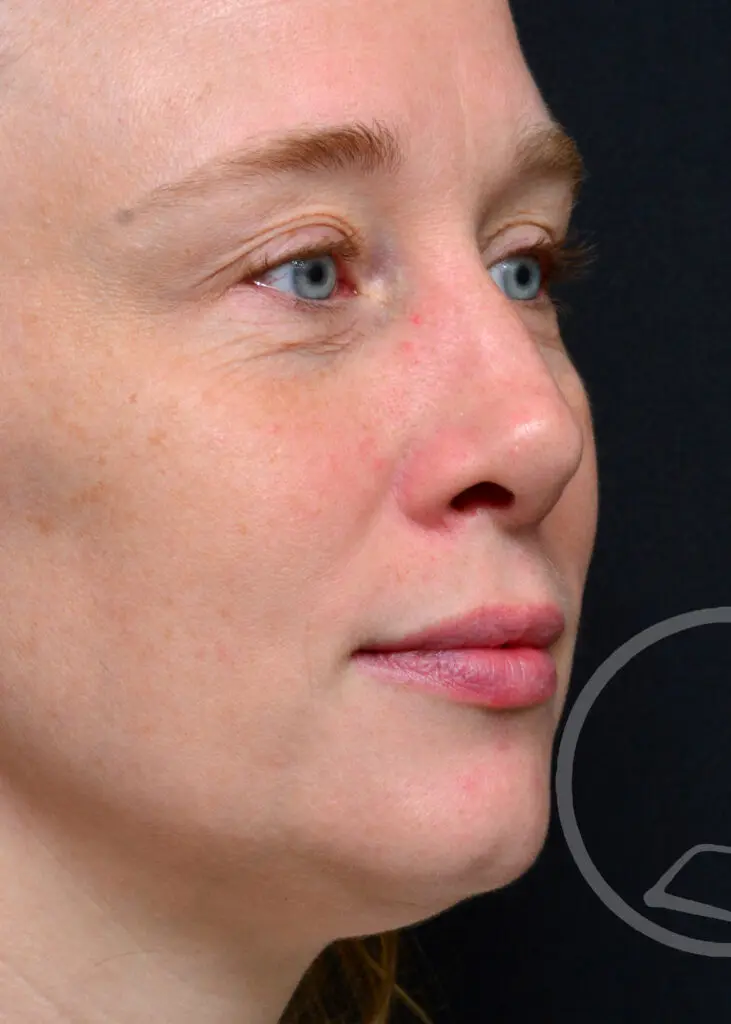 Plastic Surgery Before and After Pictures in Jacksonville, FL - Garcia Facial Plastic Surgery