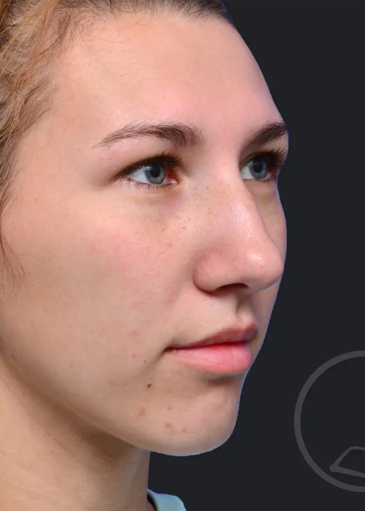 Plastic Surgery Before and After Pictures in Jacksonville, FL - Garcia Facial Plastic Surgery