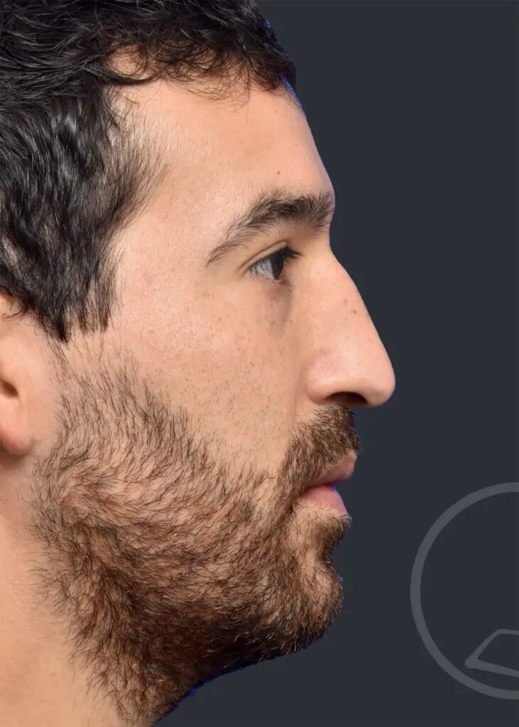 Plastic Surgery Before and After Pictures in Jacksonville, FL - Garcia Facial Plastic Surgery