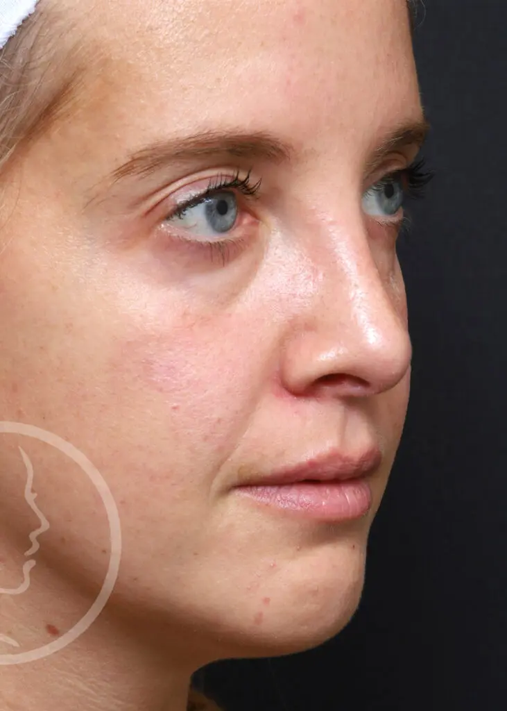 Plastic Surgery Before and After Pictures in Jacksonville, FL - Garcia Facial Plastic Surgery