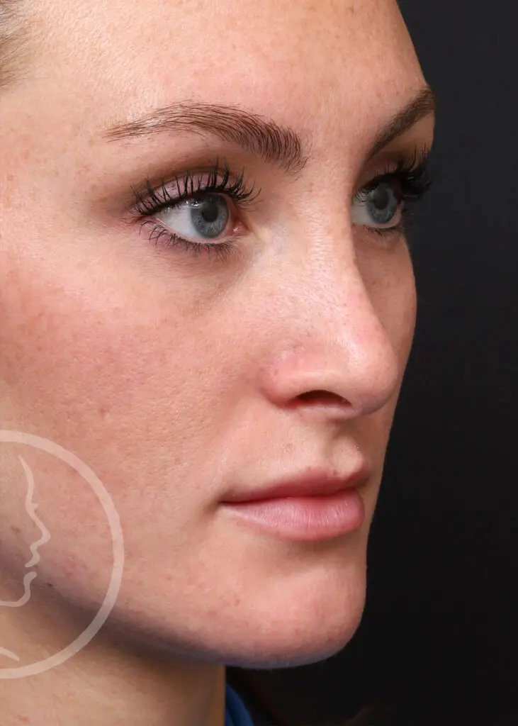 Plastic Surgery Before and After Pictures in Jacksonville, FL - Garcia Facial Plastic Surgery