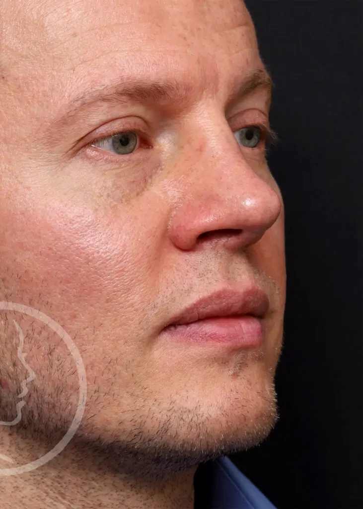 Plastic Surgery Before and After Pictures in Jacksonville, FL - Garcia Facial Plastic Surgery