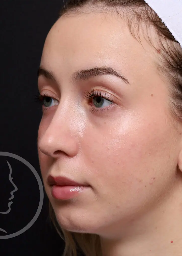 Plastic Surgery Before and After Pictures in Jacksonville, FL - Garcia Facial Plastic Surgery