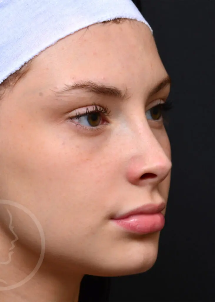 Plastic Surgery Before and After Pictures in Jacksonville, FL - Garcia Facial Plastic Surgery