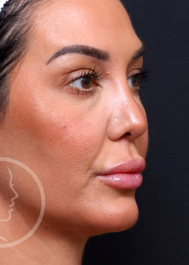 Plastic Surgery Before and After Pictures in Jacksonville, FL - Garcia Facial Plastic Surgery